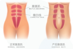 产后腹直肌修复